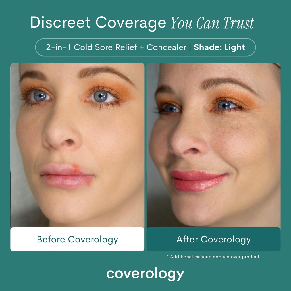 coverology-cold-sore-treatment-cold-sore-3.jpg