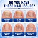 toenail-fungus-treatment-25-undecylenic--71pHdbXJbpL.jpg