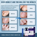 extra-strength-nail-fungus-treatment---e-5.jpg