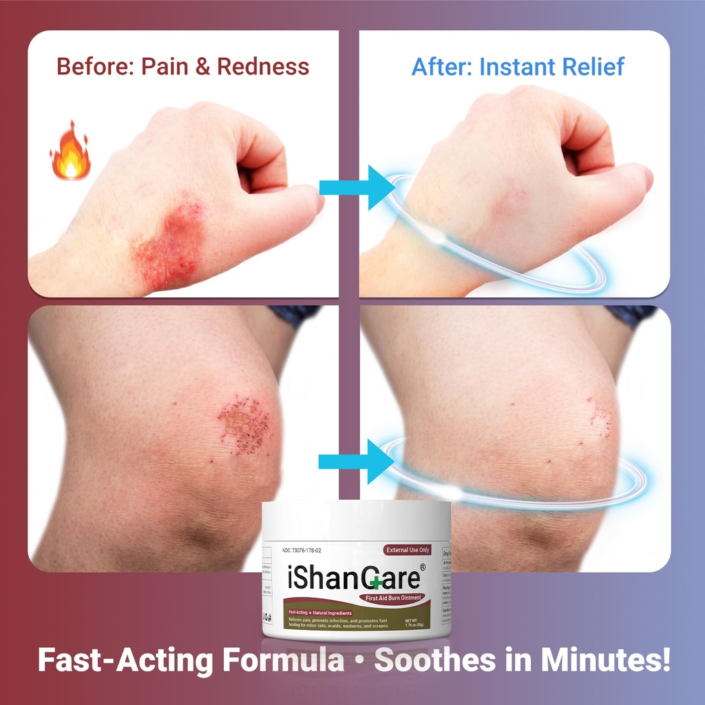 first-aid-burn-ointment-with-camellia-oi-717NFS+oh7L.jpg
