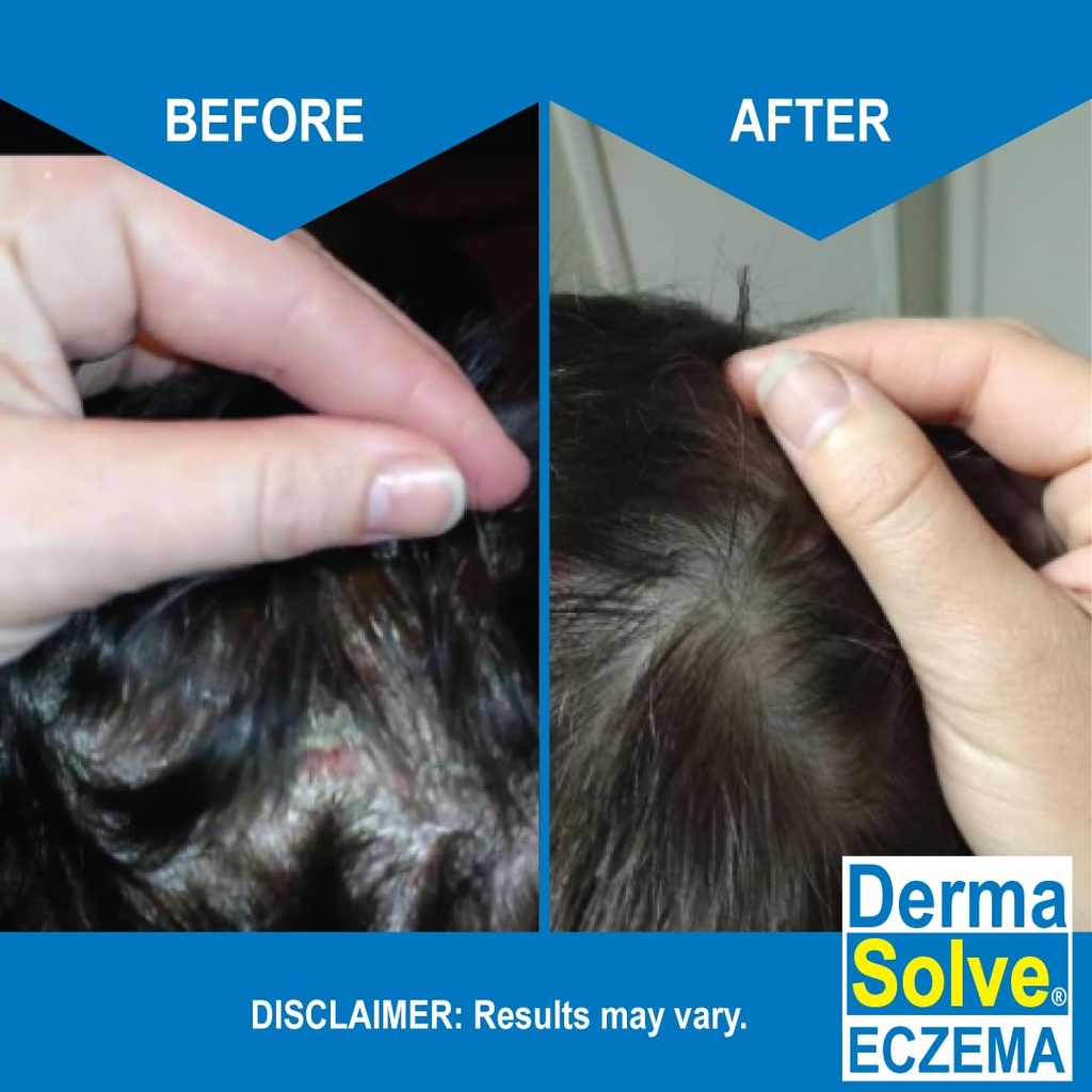 dermasolve-eczema-relief-shampoo---flare-3.jpg