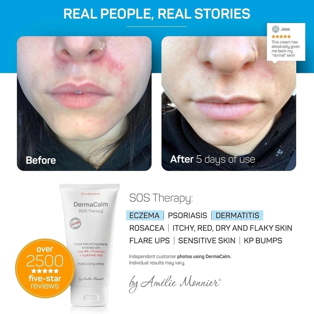 clinically-tested-dermacalm-sos-therapy--4.jpg