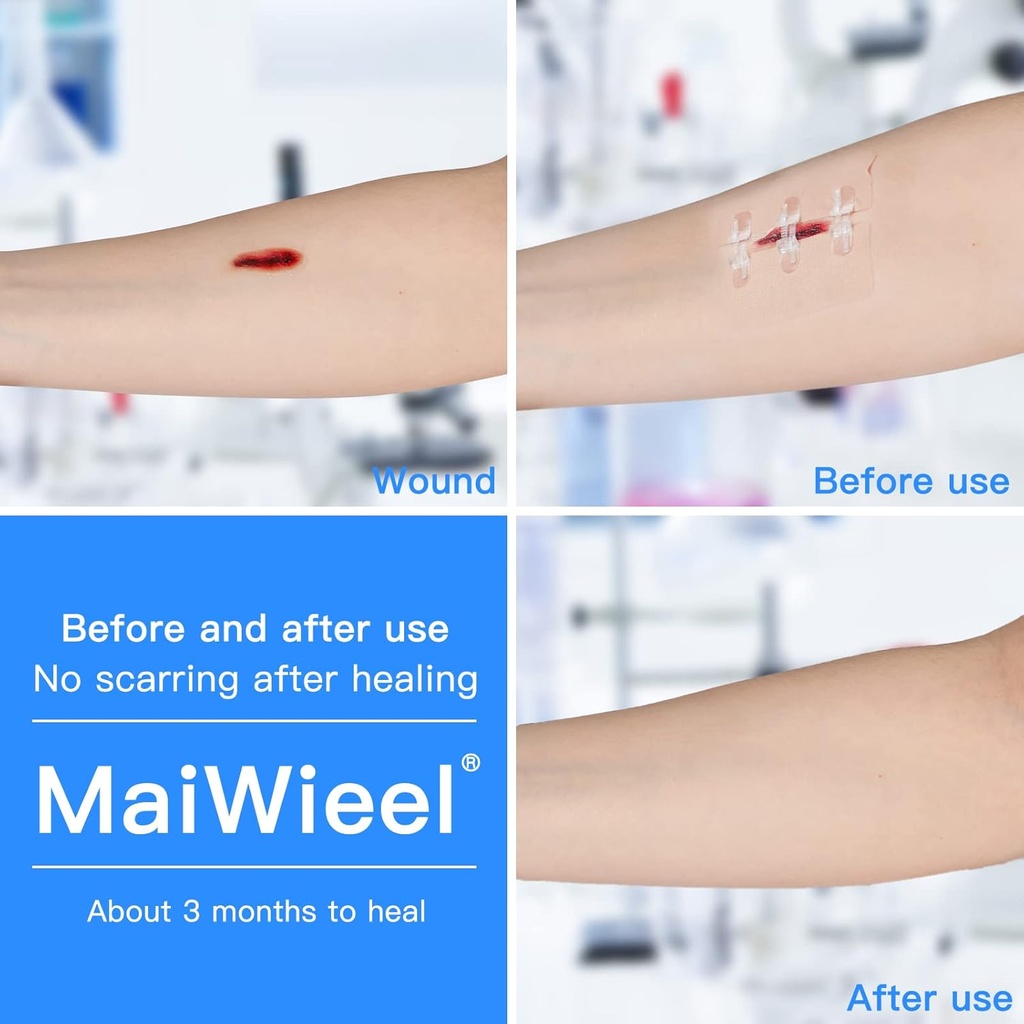 zip-stitch-laceration-repair-without-sti-3.jpg